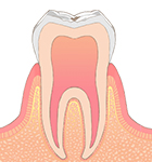 初期むし歯 画像