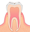 初期むし歯 画像