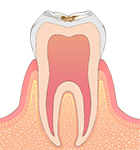 エナメル質のむし歯 画像
