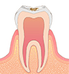 エナメル質のむし歯 画像