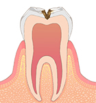 象牙質まで進んだむし歯 画像