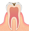 象牙質まで進んだむし歯 画像