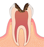 神経まで進んだむし歯 画像