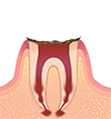 歯根だけ残ったむし歯 画像