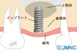 ソケットリフト 画像