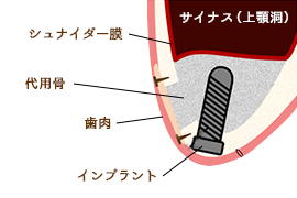 サイナスリフト 画像