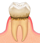 歯肉炎 画像