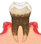 歯周病重度 画像
