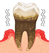 歯周病重度 画像